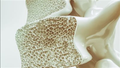 في يومه العالمي.. كيف تحمي طفلك من هشاشة العظام