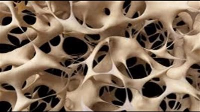 في اليوم العالمي لهشاشة العظام.. نصائح ذهبية لحماية عظامك