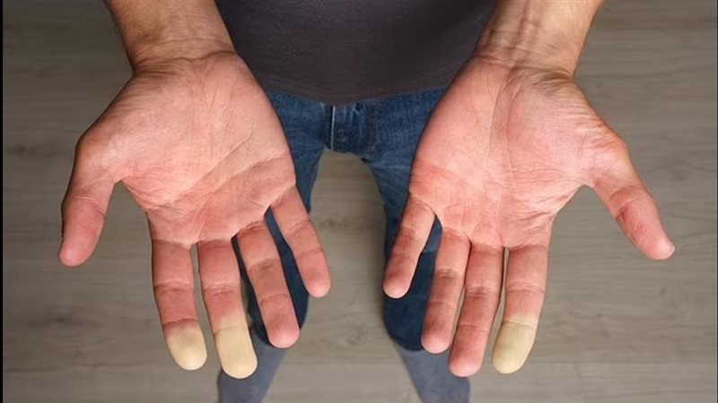 متلازمة برودة الأطراف