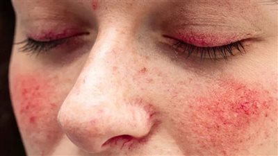 الذئبة الحمراء: لماذا تستهدف النساء وكيف يمكن التعايش معها؟