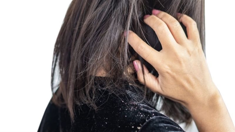 قشرة الشعر