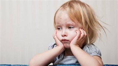 كل ما تحتاج معرفته عن الجدرى: الأعراض وفترة الحضانة وطرق التشخيص