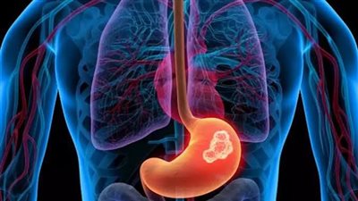 تجنب هذه الأطعمة يوميًا.. قد تزيد من خطر الإصابة بسرطان الجهاز الهضمي