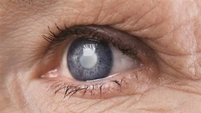 هل تعود المياه البيضاء بعد الجراحة؟.. اكتشف حقيقة الإعتام الثانوي