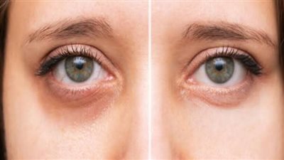 هل تعاني من الهالات السوداء؟ قد تكون هذه إشارة لمشاكل في الكبد