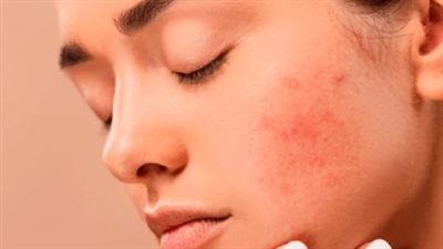 طرق فعالة لحماية بشرتك من حب الشباب والحفاظ على إشراقتها الدائمة