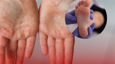 أعراض متشابهة ومضاعفات مختلفة.. طبيب يكشف الفرق بين «كوكساكي والجديري» 