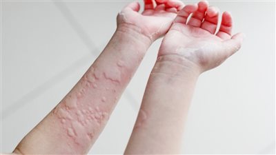 حساسية نادرة تحول الاستحمام إلى كابوس.. ما هى «حساسية الماء»؟