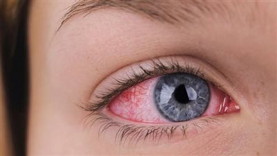 التهابات العين في فصل الصيف.. كيف تتجنبها وما هو العلاج المناسب؟