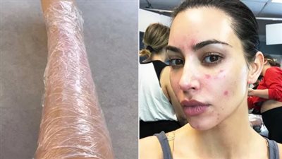 «مرض جلدي مناعي» يُجبر كيم كارداشيان على تغليف جسدها بالبلاستيك… ما القصة؟
