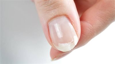 لون وشكل أظافرك قد ينقذك.. مؤشرات صحية لا يجب تجاهلها