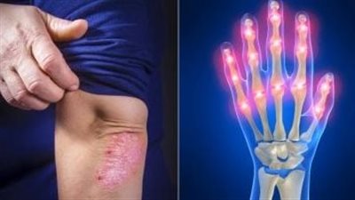 آلام المفاصل.. أبرز الأسباب الصحية ومتى يجب استشارة الطبيب