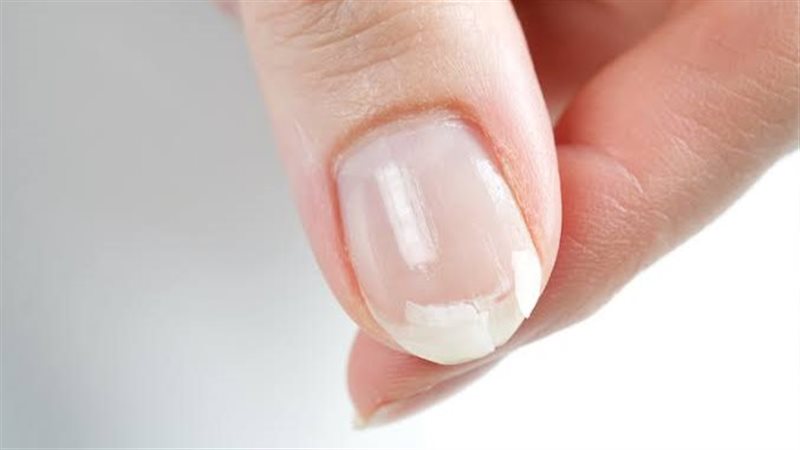 أمراض تظهر على الأظافر