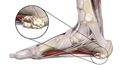 «الشوكة العظمية» ليست مجرد ألم في الكعب.. إليك أسبابها وأفضل طرق العلاج