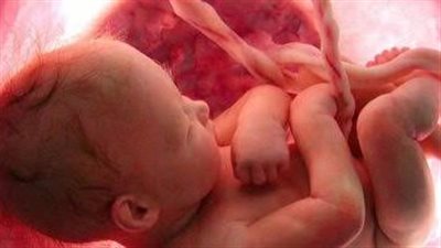 تشوهات خلقية ومضاعفات نادرة.. ما لا تعرفه عن متلازمة السائل الأمينوسي