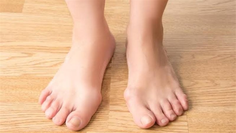 أعراض تليف الكبد