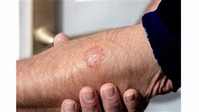 المضادات الحيوية ليست الحل.. 10 خرافات شائعة عن «السعفة الجلدية»