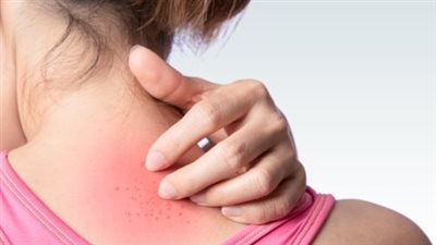 مع اشتداد الحر.. طرق فعّالة للوقاية من التهابات الجلد والطفح الحرارية