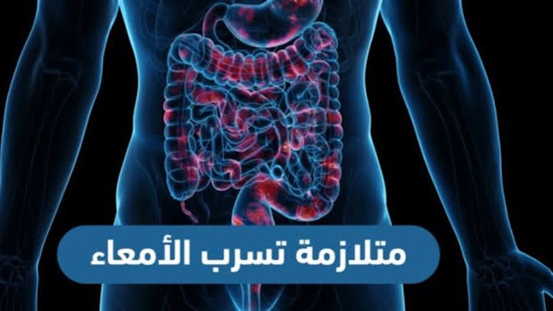 متلازمة تسرب الأمعاء