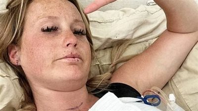 حقنة «بوتوكس» تنقلب كارثة.. إصابة سيدة بالشلل بعد جلسة تجميل 