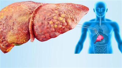 احذرها.. علامات تدل على الكبد الدهني لدى الطفل 