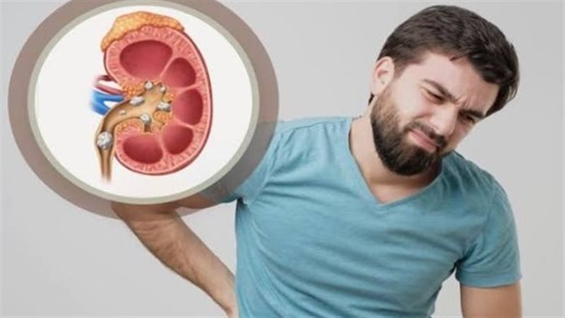 حصوات الكلى