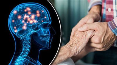 إنجاز طبي تاريخي.. علاج جيني يبطئ «مرض هنتنغتون»