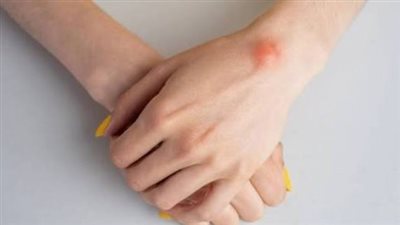 «الأكياس العقدية».. نتوءات حميدة قرب المفاصل تستدعي العلاج