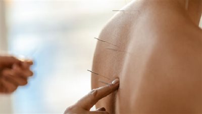 تجربة تكشف فاعلية «الوخز بالإبر» لتسكين آلام الظهر
