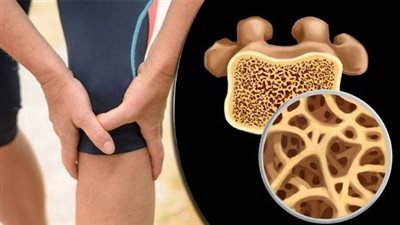 أبرز «أعراض هشاشة العظام» لدى الرجال والنساء