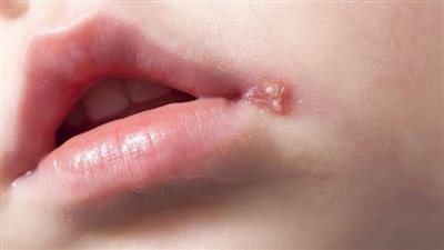 ما هو فيروس «الهربس».. الأعراض وطرق الوقاية