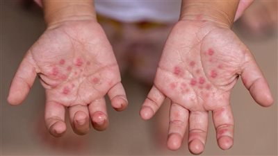 احذر العدوى.. «فيروس المدارس» يصيب الأطفال بأعراض خطيرة