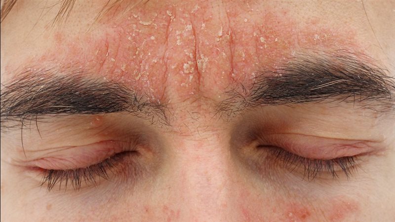 إكزيما الوجه