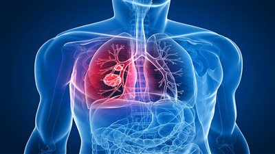 سرطان الرئة «القاتل الصامت».. اكتشف أعراضه وأسباب الإصابة