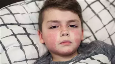 للأمهات.. علامات تميز بين كاواساكي والحمى القرمزية