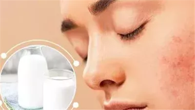 أطعمة شائعة تفسد بشرتك.. اعرف مسببات حب الشباب