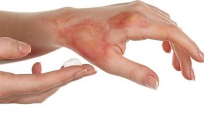 «حروق الدرجة الثانية».. كيف تحدد نوعها وطرق علاجها