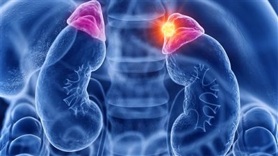 مرض أديسون النادر.. تعرف على الأسباب والأعراض الخطيرة