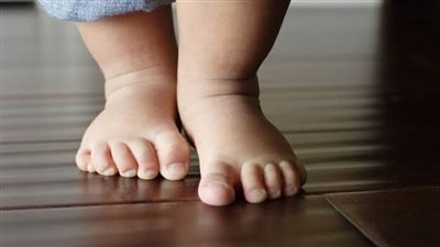 أعراض مرض الكساح وعلاقته بنقص فيتامين د الشهير