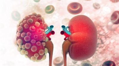 أعراض مفاجئة تكشف الإصابة المبكرة بسرطان الكلى