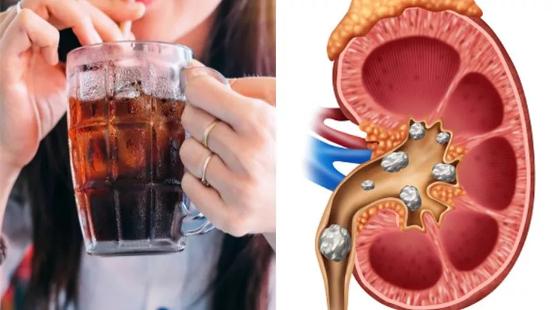 مشروبات تضر الكلي