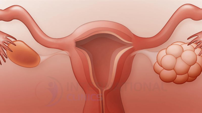 تكيس المبايض